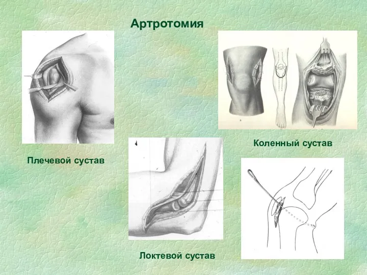 Артротомия Плечевой сустав Коленный сустав Локтевой сустав