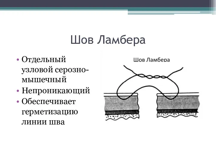 Шов Ламбера Отдельный узловой серозно-мышечный Непроникающий Обеспечивает герметизацию линии шва