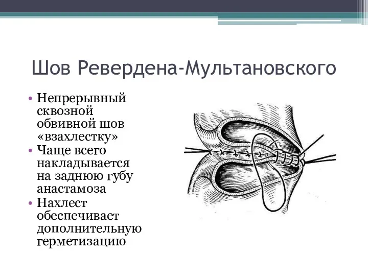 Шов Ревердена-Мультановского Непрерывный сквозной обвивной шов «взахлестку» Чаще всего накладывается