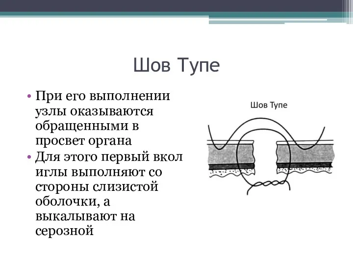 Шов Тупе При его выполнении узлы оказываются обращенными в просвет