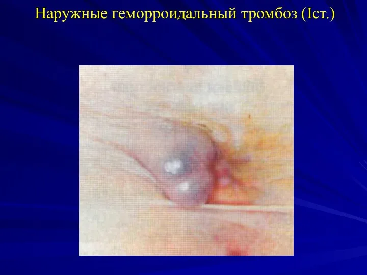 Наружные геморроидальный тромбоз (Iст.)