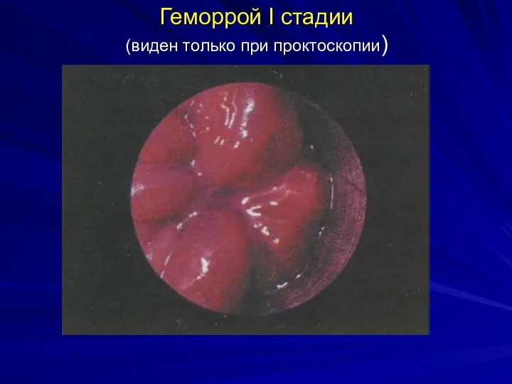 Геморрой I стадии (виден только при проктоскопии)