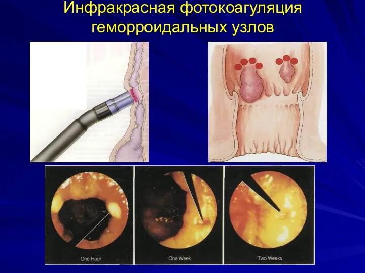 Инфракрасная фотокоагуляция геморроидальных узлов