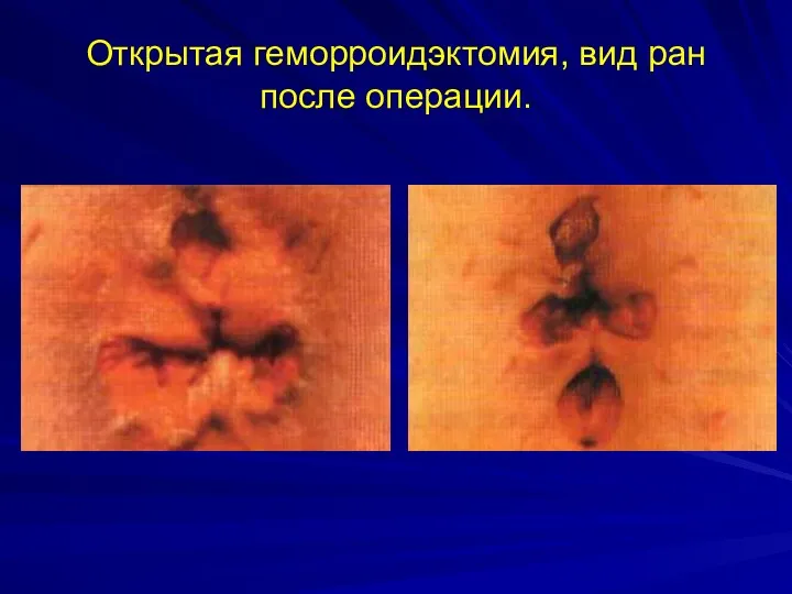 Открытая геморроидэктомия, вид ран после операции.
