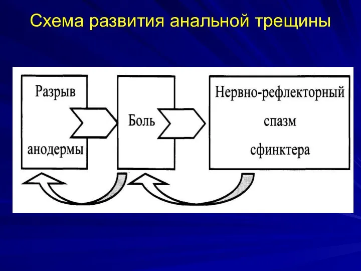 Схема развития анальной трещины