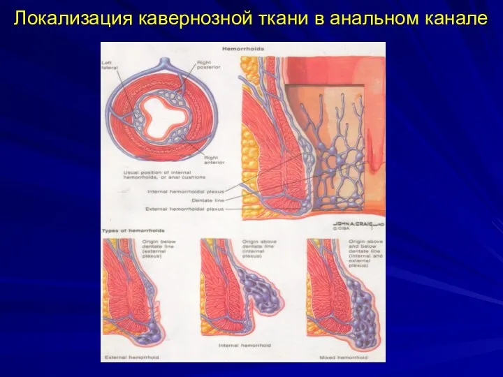 Локализация кавернозной ткани в анальном канале