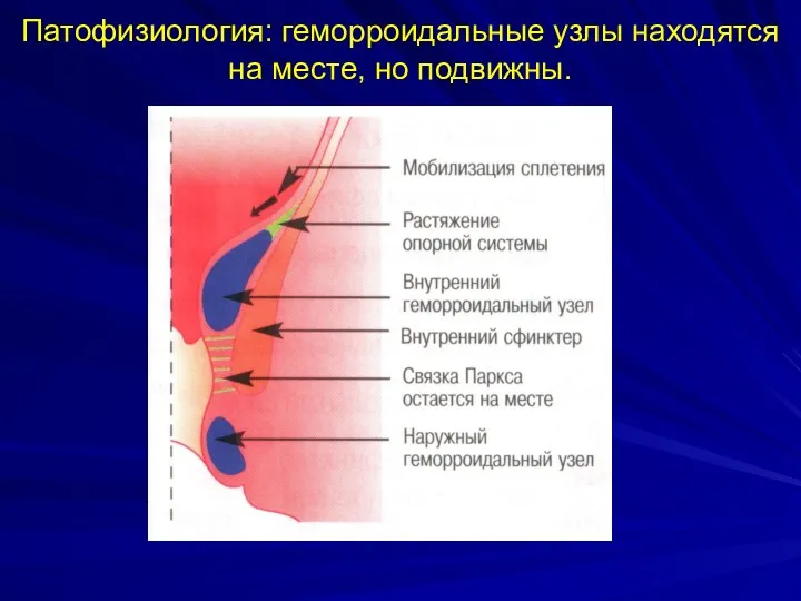 Патофизиология: геморроидальные узлы находятся на месте, но подвижны.