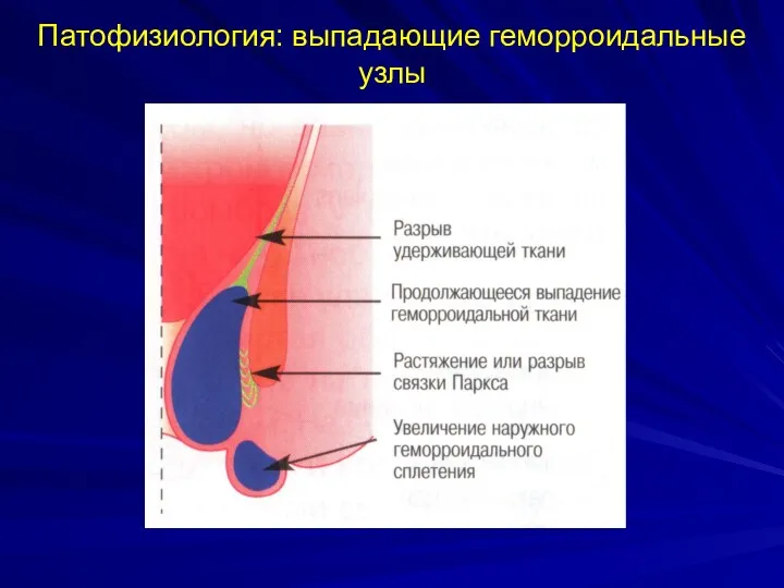 Патофизиология: выпадающие геморроидальные узлы