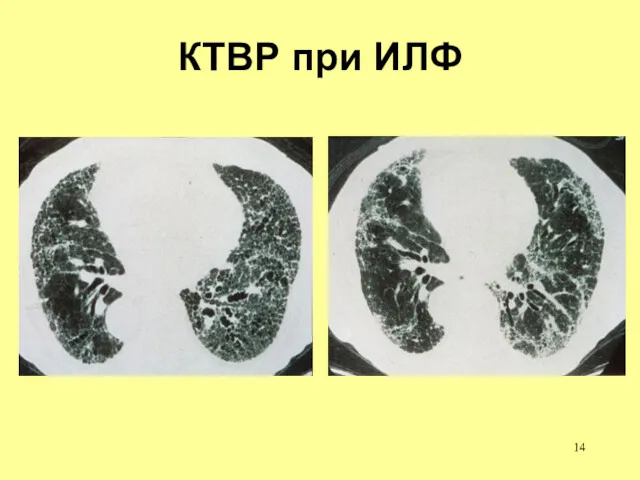 КТВР при ИЛФ