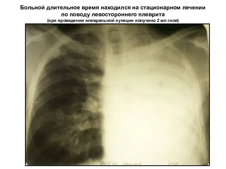 Больной длительное время находился на стационарном лечении по поводу левостороннего