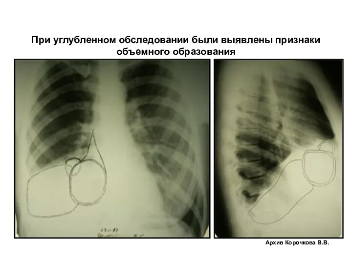 При углубленном обследовании были выявлены признаки объемного образования Архив Корочкова В.В.