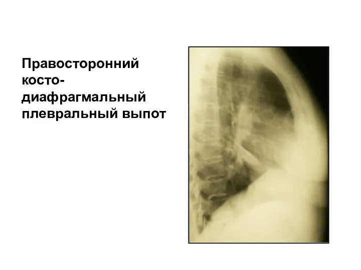 Правосторонний косто-диафрагмальный плевральный выпот