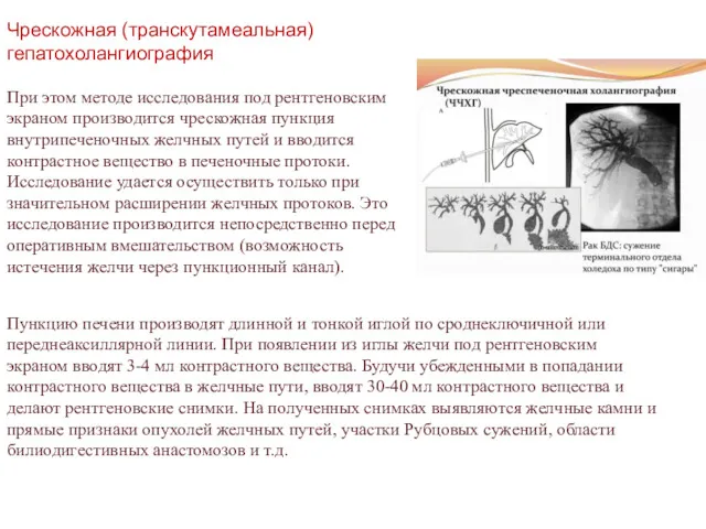 Чрескожная (транскутамеальная) гепатохолангиография При этом методе исследования под рентгеновским экраном производится чрескожная пункция