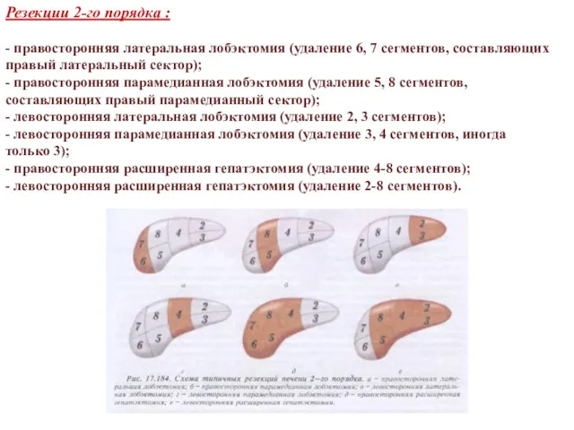 Резекции 2-го порядка : - правосторонняя латеральная лобэктомия (удаление 6,