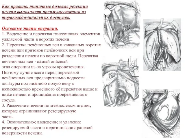 Как правило, типичные долевые резекции печени выполняют преимущественно из торакоабдоминальных