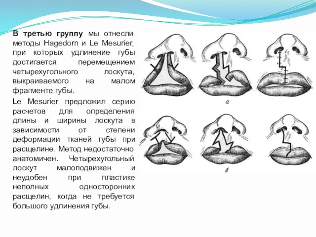 В третью группу мы отнесли методы Hagedorn и Le Меsurier,