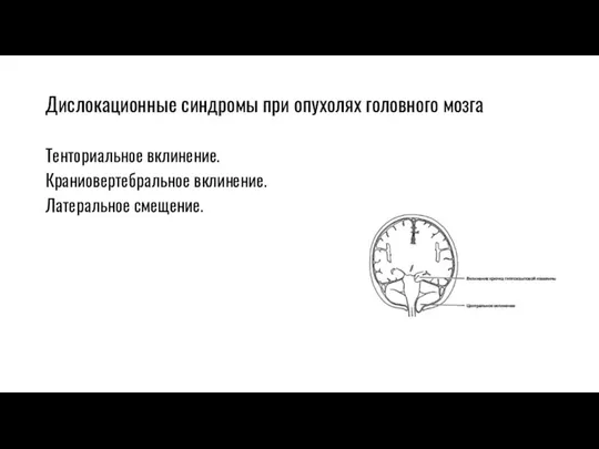 Дислокационные синдромы при опухолях головного мозга Тенториальное вклинение. Краниовертебральное вклинение. Латеральное смещение.