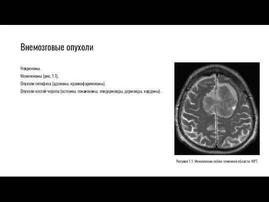 Внемозговые опухоли Невриномы. Менингиомы (рис. 1.1). Опухоли гипофиза (аденомы, краниофарингиомы).