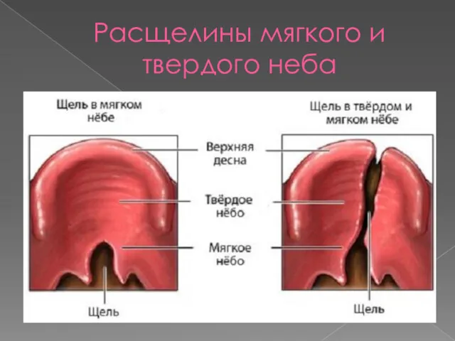 Расщелины мягкого и твердого неба