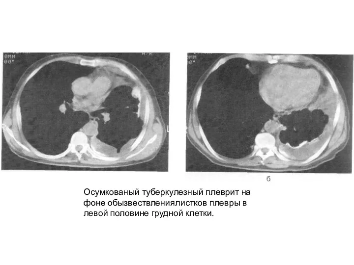 Осумкованый туберкулезный плеврит на фоне обызвествлениялистков плевры в левой половине грудной клетки.