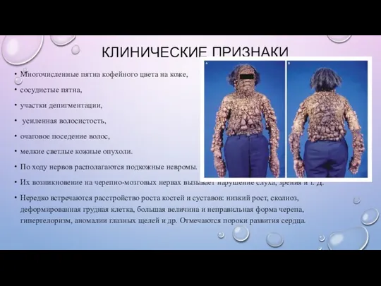 КЛИНИЧЕСКИЕ ПРИЗНАКИ Многочисленные пятна кофейного цвета на коже, сосудистые пятна,