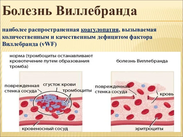 Болезнь Виллебранда наиболее распространенная коагулопатия, вызываемая количественным и качественным дефицитом фактора Виллебранда (vWF)