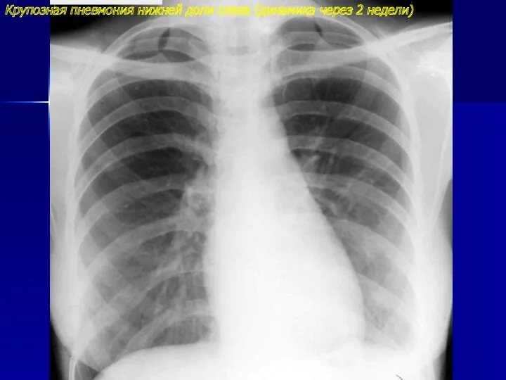 Крупозная пневмония нижней доли слева (динамика через 2 недели)
