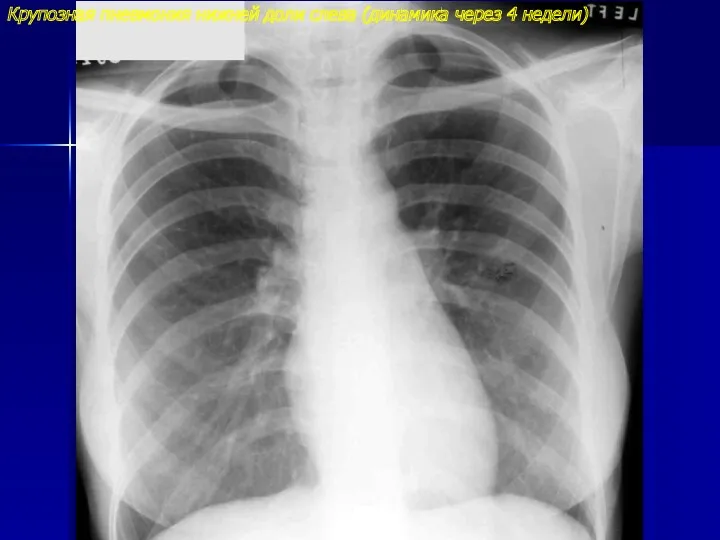 Крупозная пневмония нижней доли слева (динамика через 4 недели)