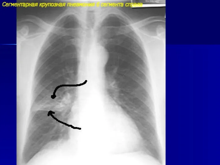 Сегментарная крупозная пневмония 6 сегмента справа
