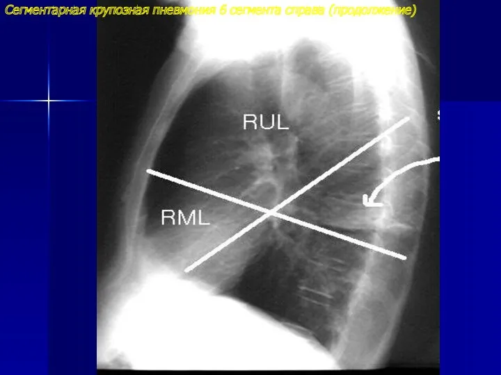 Сегментарная крупозная пневмония 6 сегмента справа (продолжение)