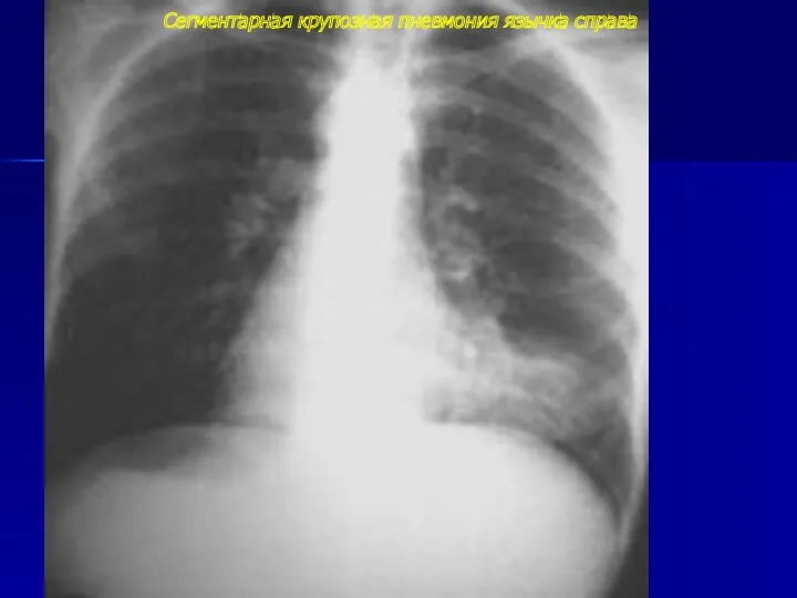 Сегментарная крупозная пневмония язычка справа