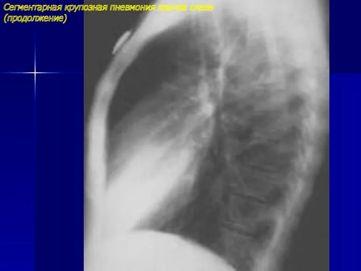 Сегментарная крупозная пневмония язычка слева (продолжение)