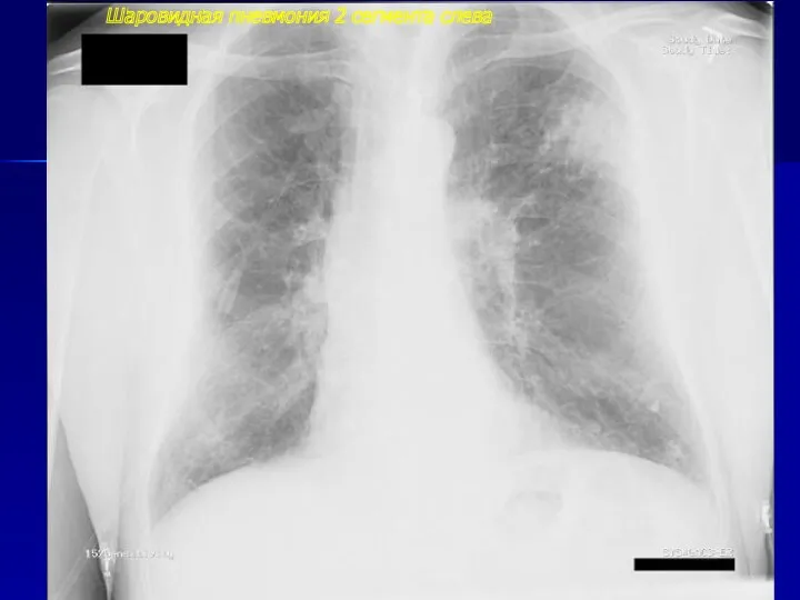 Шаровидная пневмония 2 сегмента слева