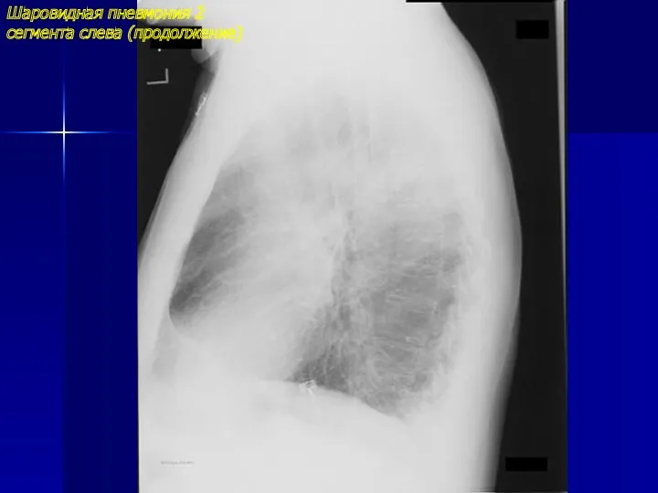 Шаровидная пневмония 2 сегмента слева (продолжение)