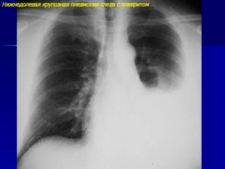 Нижнедолевая крупозная пневмония слева с плевритом