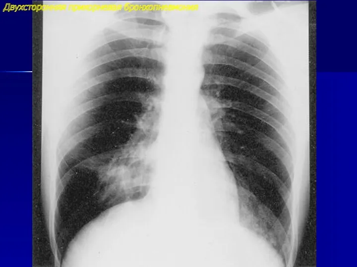 Двухсторонняя прикорневая бронхопневмония