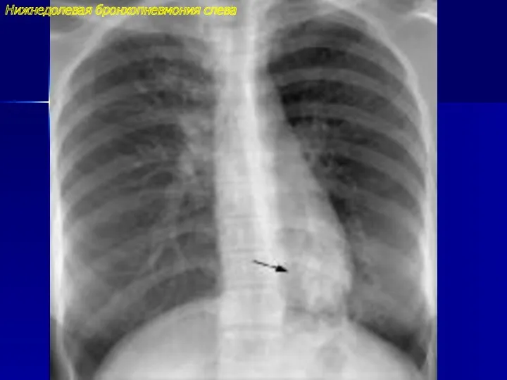 Нижнедолевая бронхопневмония слева