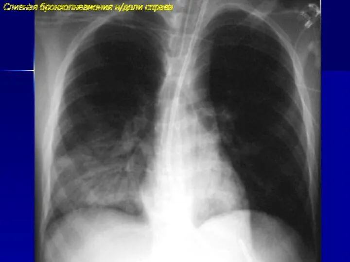 Сливная бронхопневмония н/доли справа