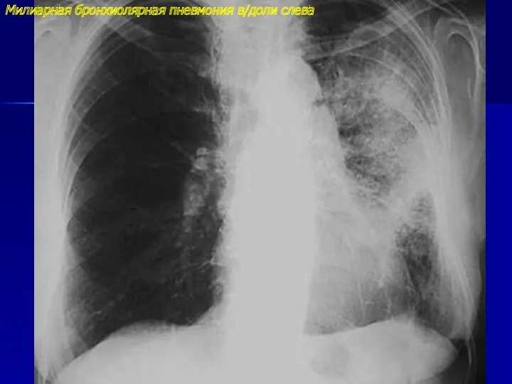 Милиарная бронхиолярная пневмония в/доли слева