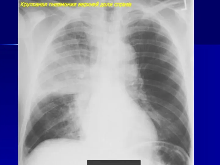 Крупозная пневмония верхней доли справа
