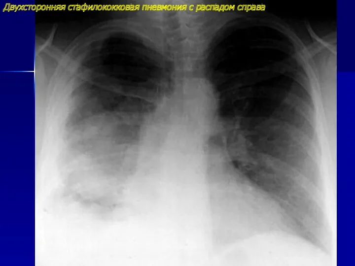 Двухсторонняя стафилококковая пневмония с распадом справа