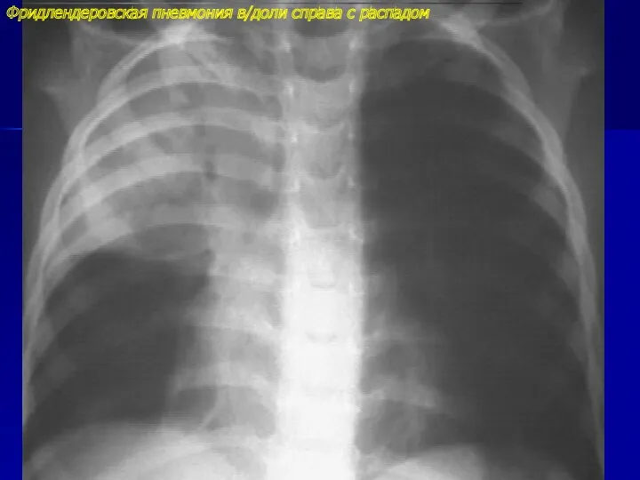 Фридлендеровская пневмония в/доли справа с распадом