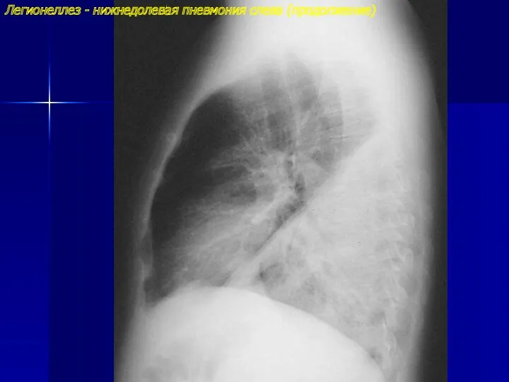 Легионеллез - нижнедолевая пневмония слева (продолжение)