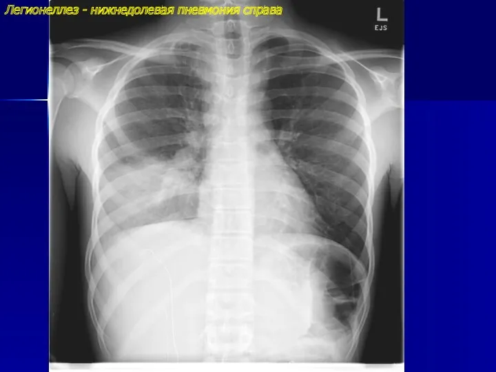 Легионеллез - нижнедолевая пневмония справа