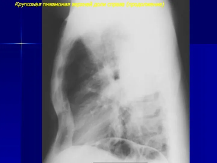 Крупозная пневмония верхней доли справа (продолжение)