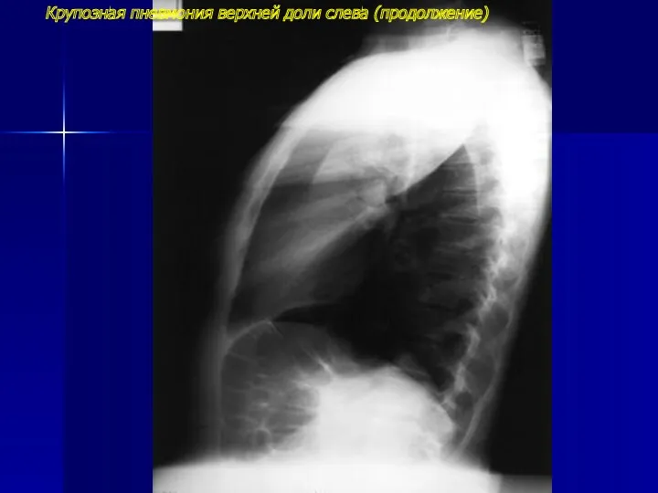 Крупозная пневмония верхней доли слева (продолжение)