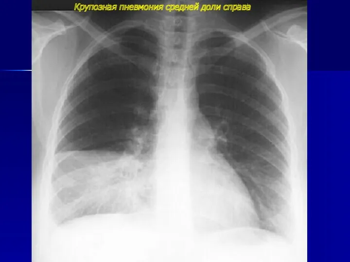 Крупозная пневмония средней доли справа