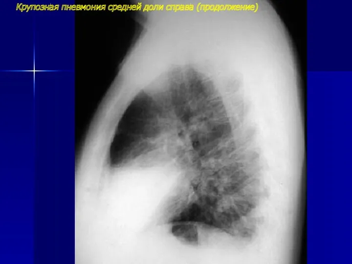 Крупозная пневмония средней доли справа (продолжение)
