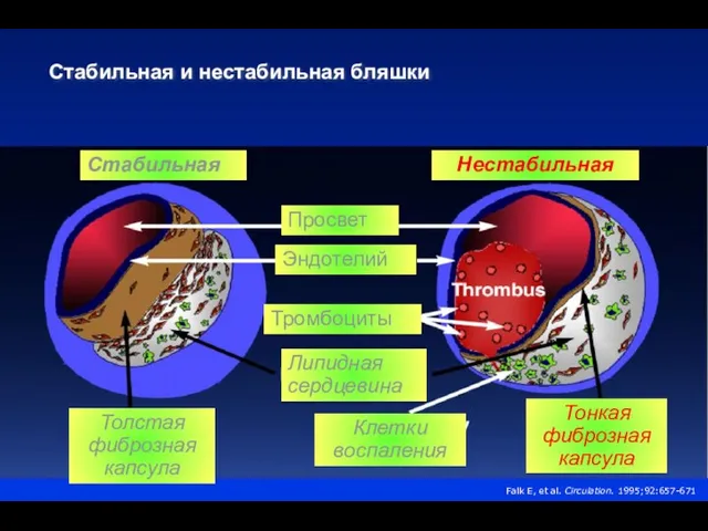 Стабильная и нестабильная бляшки Falk E, et al. Circulation. 1995;92:657-671