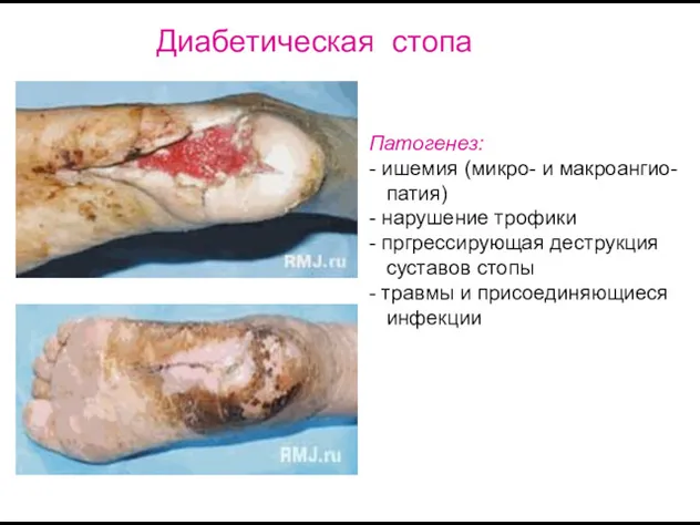 Патогенез: - ишемия (микро- и макроангио- патия) - нарушение трофики